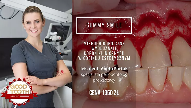Kurs: Gummy Smile – mikrochirurgiczne wydłużanie koron klinicznych w odcinku estetycznym
