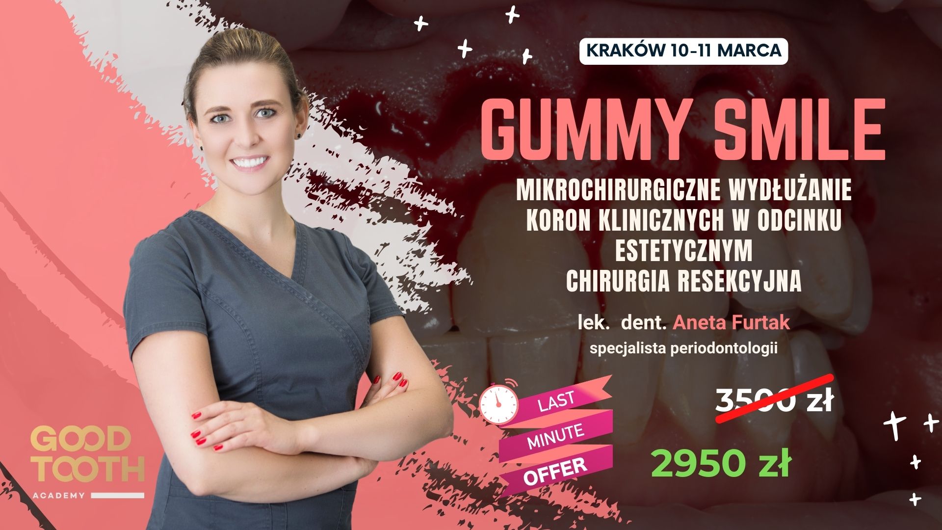 Kurs: Gummy Smile – mikrochirurgiczne wydłużanie koron klinicznych w odcinku estetycznym, chirurgia resekcyjna