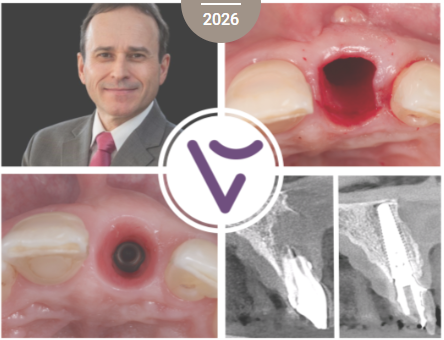 Immediate dentoalveolar restoration course